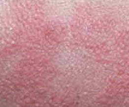 Clinical example — papule